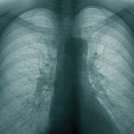 Obstrukcinis bronchitas – Ką būtina žinoti?