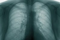 Bronchito rentgeno nuotrauka