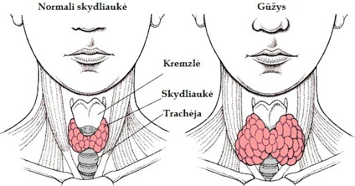Kas yra skydliaukės sutrikimai 5 Kas yra skydliaukės sutrikimai