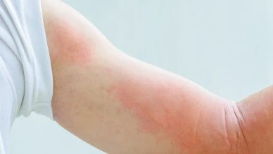 Kodėl atsiranda egzemos ir kaip jas sumažinti? 17 egzema