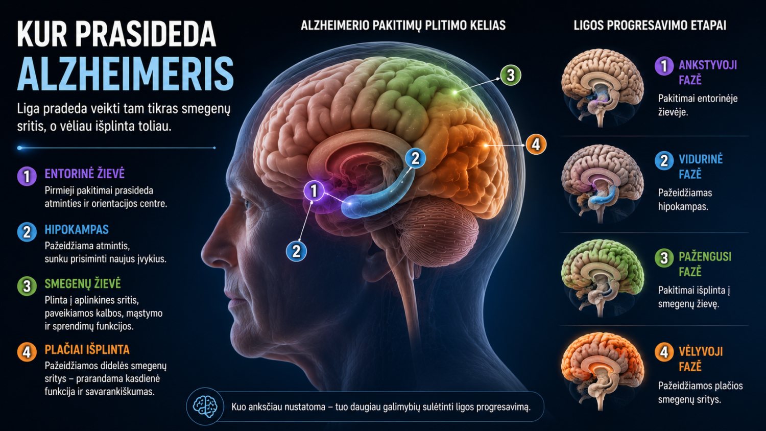 Alzheimerio liga - Simptomai ir gydymas 2 Smegenų paveikslas su Alzheimerio ligos progresijos etapais ir simptomais.