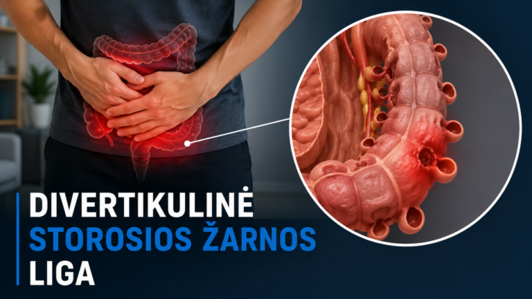 Divertikulinė storosios žarnos liga 5 Divertikulinė storosios žarnos liga