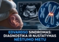 Edvardso sindromas: Diagnostika ir nustatymas nėstumo metu. Genetikos specialistas perspėja. 2 Edvardso sindromas: Diagnostika ir nustatymas nėstumo metu. Genetikos specialistas perspėja.