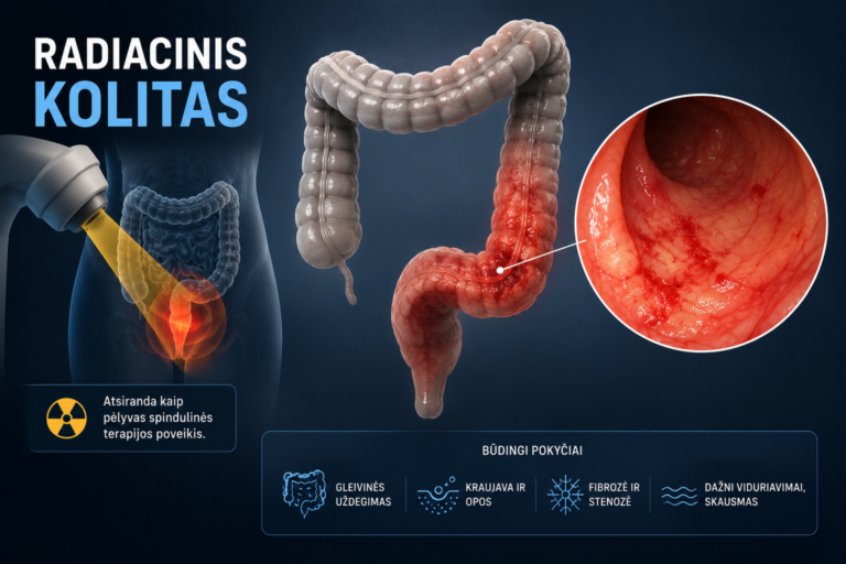 Radiacinis kolitas